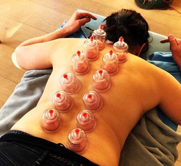 Dry cupping
